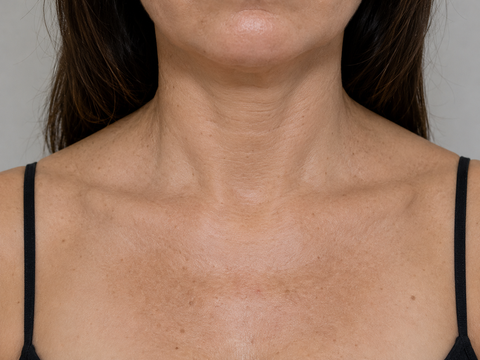 Before · Décolletage
