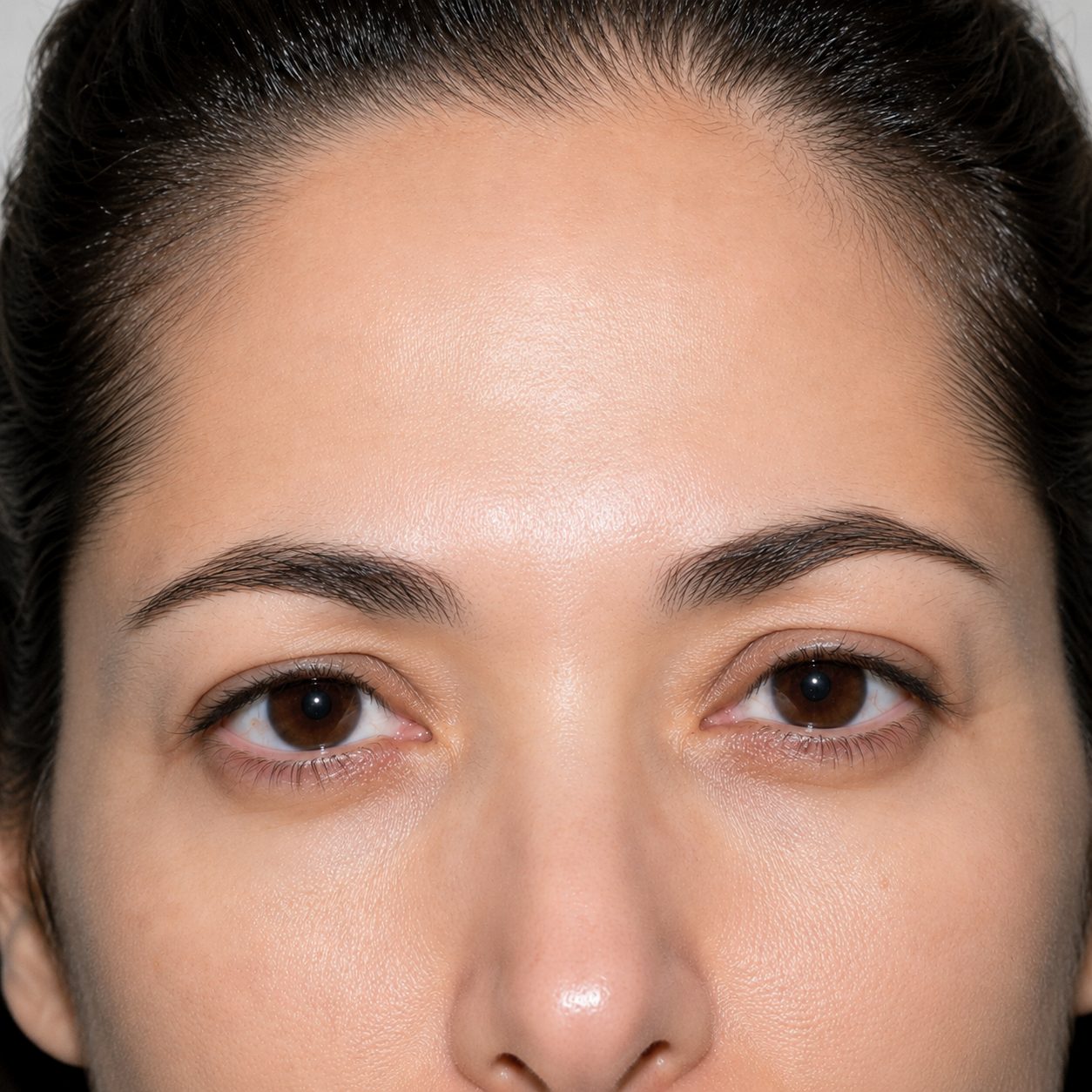 Reduced wrinkles & fine lines — after