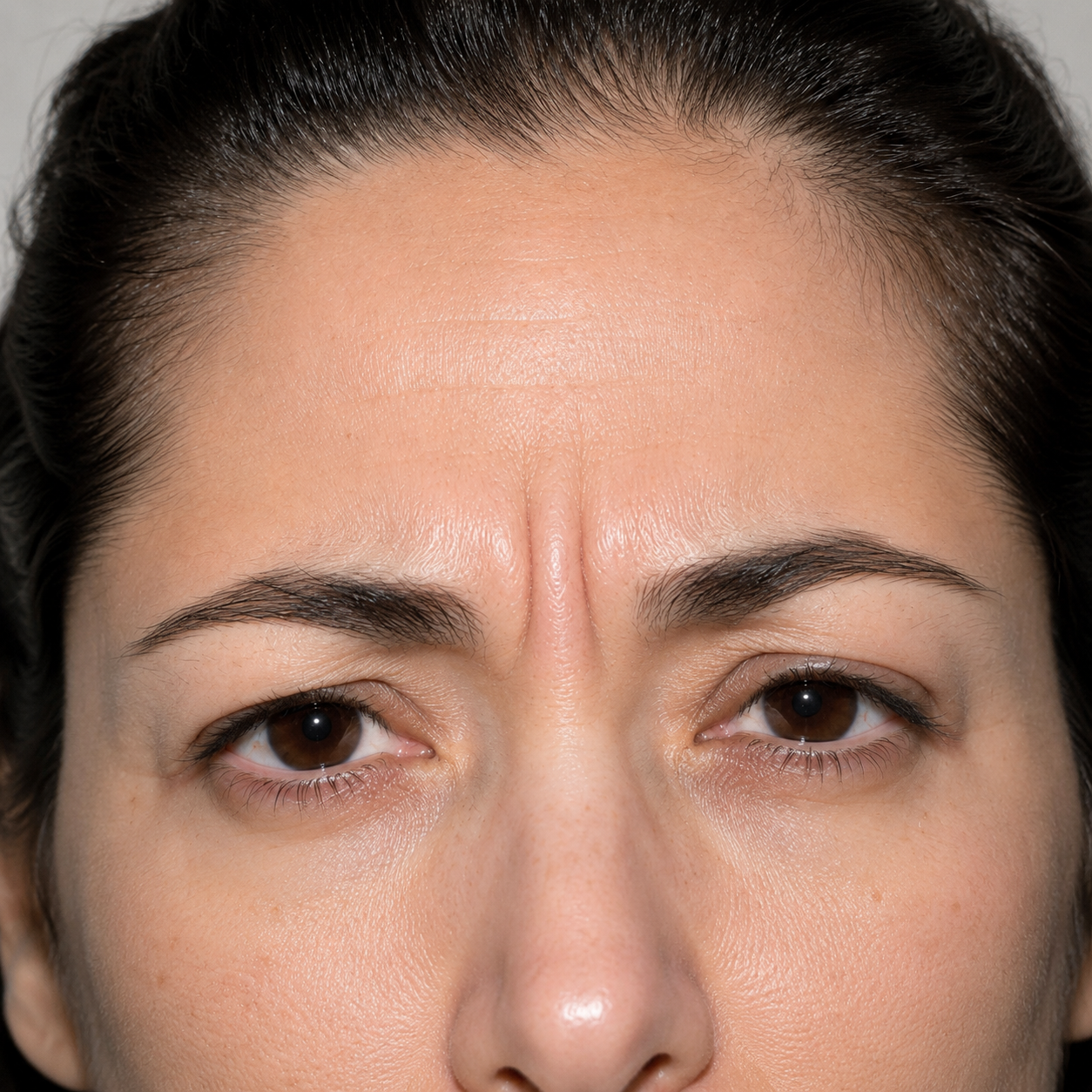 Reduced wrinkles & fine lines — before